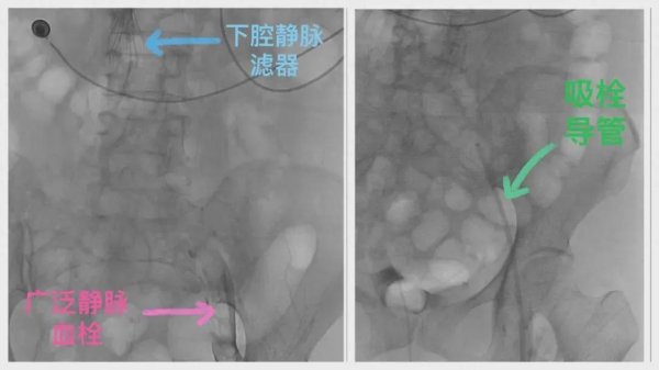 开云kaiyun官方网站“一键式”科罚患者下肢深静脉血栓与髂静脉压迫勤恳-kaiyun体育在线官网